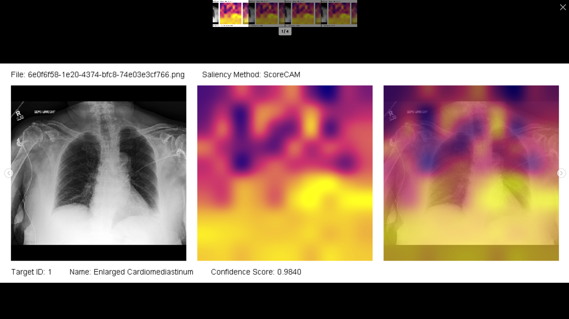 AuroXRay heatmap visualization for enlarged cardiomediastinum classification