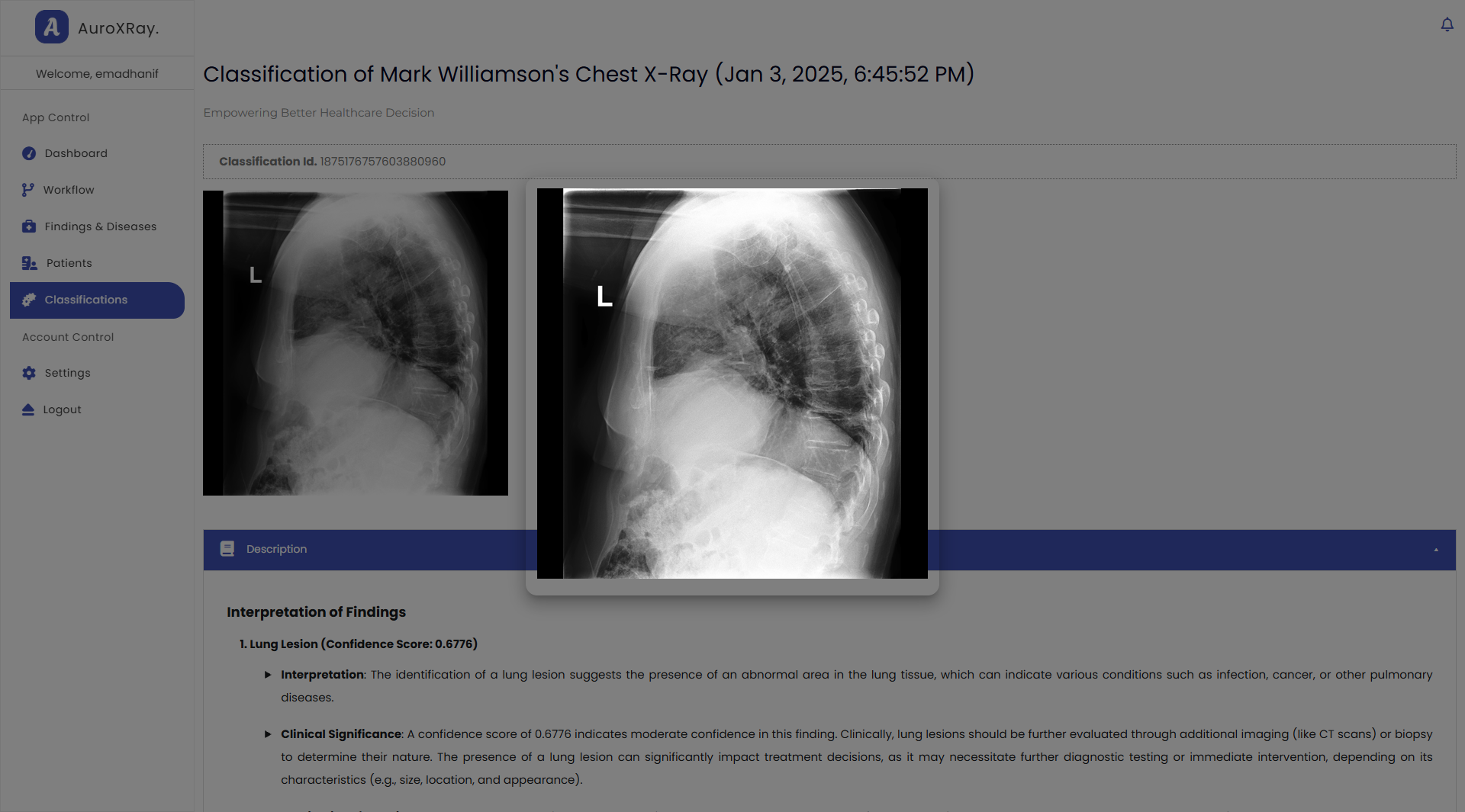 Chest X-ray image uploaded to AuroXRay for classification