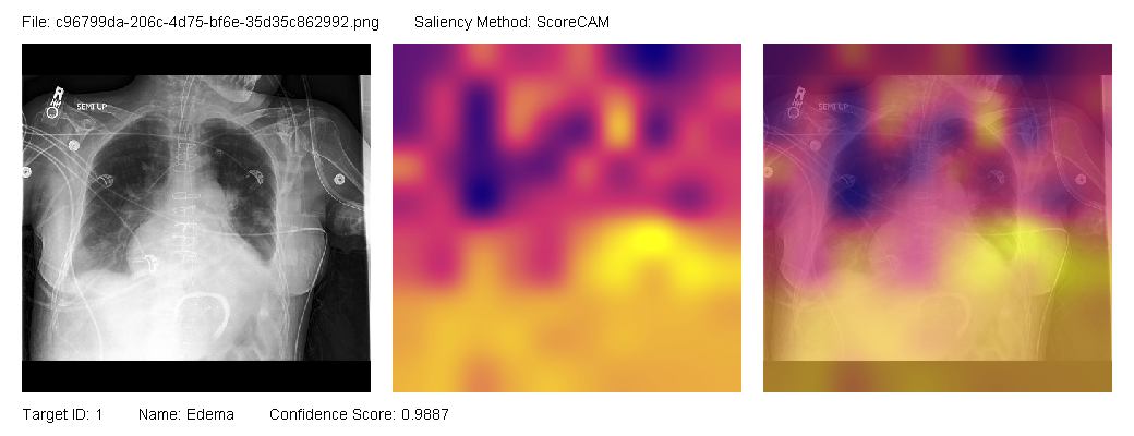 AuroXRay heatmap visualization showing saliency regions on a chest X-ray: bright yellow highlights the most salient areas, purple indicates moderate importance, and dark blue shows low-saliency regions